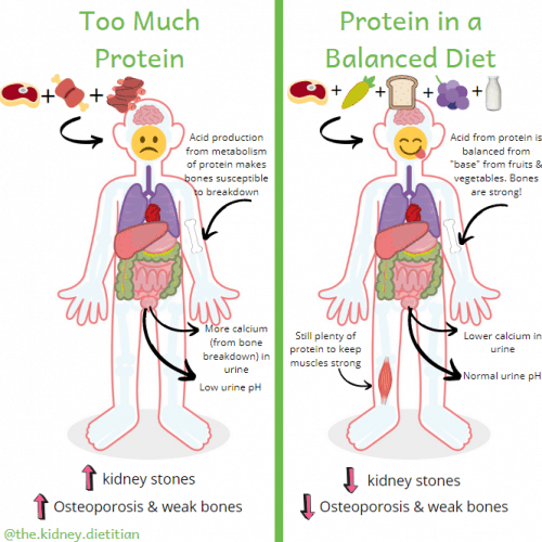 The Kidney Stone Diet Nutrition to Prevent Calcium Oxalate Kidney