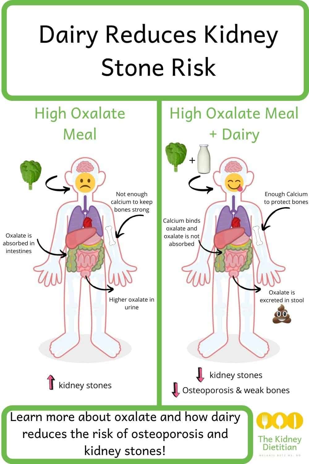 The Kidney Stone Diet Nutrition to Prevent Calcium Oxalate Kidney