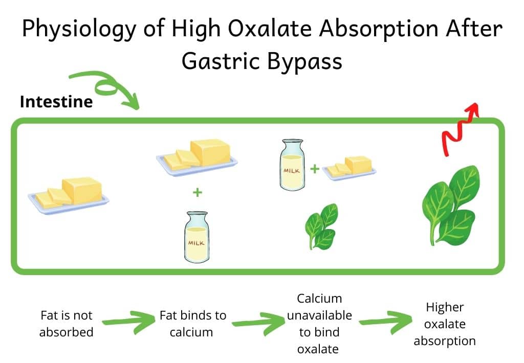 Picture illustrating higher oxalate absorption after gastric bypass. In the intestine, fat is not absorbed and binds to calcium. Calcium is unavailable to bind oxalate, which causes higher oxalate absorption and risk of kidney stones.