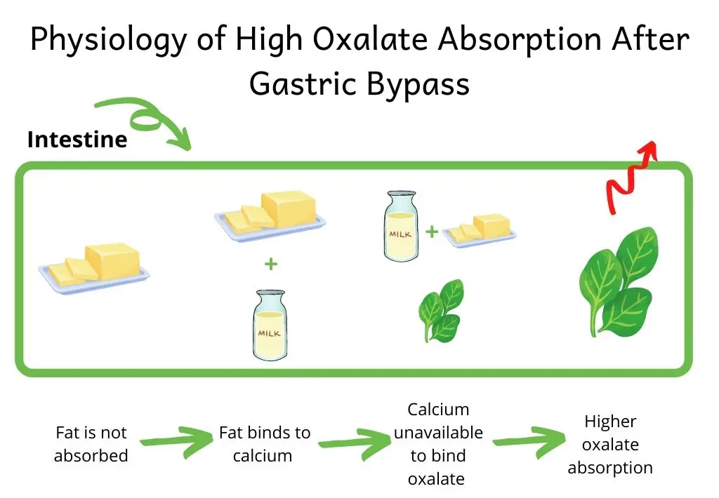 Picture illustrating higher oxalate absorption after gastric bypass. In the intestine, fat is not absorbed and binds to calcium. Calcium is unavailable to bind oxalate, which causes higher oxalate absorption and risk of kidney stones.