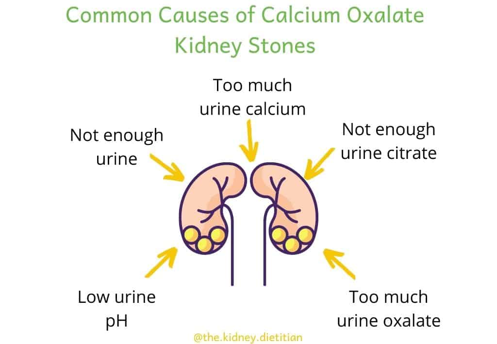 Image of kidneys with kidney stones; common causes of calcium oxalate kidney stones listed around image: too much urine calcium, not enough urine citrate, too much urine oxalate, low urine pH, not enough urine