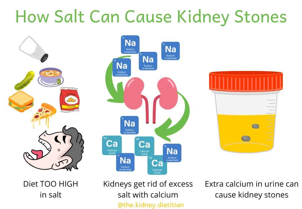 Picture of how salt can cause kidney stones: diet too high in salt, then the kidneys get rid of excess salt with calcium, then the extra calcium in urine can cause kidney stones