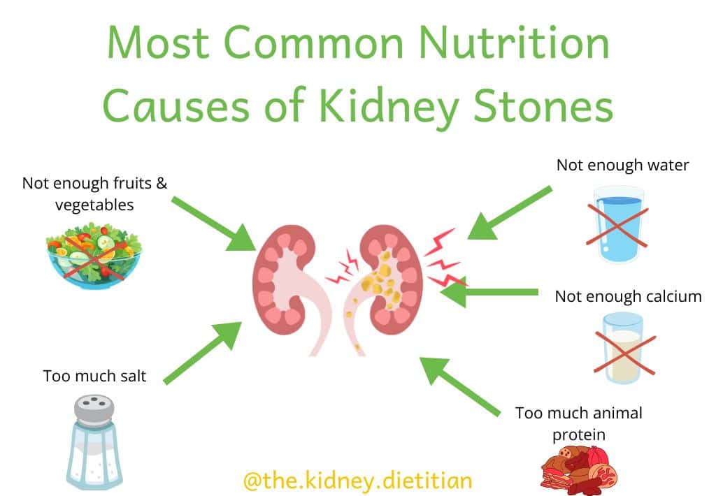 Title: Most Common Nutrition Causes of Kidney Stones with images for each cause: not enough fruits & vegetables, not enough water, not enough calcium, too much animal protein and too much salt