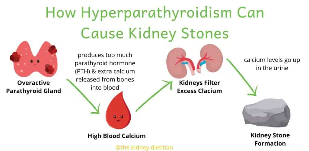 Infographic showing how hyperparathyroidism can cause kidney stones: Overactice parathyroid gland produces too much PTH and extra calcium is released into the blood, the kidneys filter excess calcium, calcium levels go up in urine and then kidney stones form